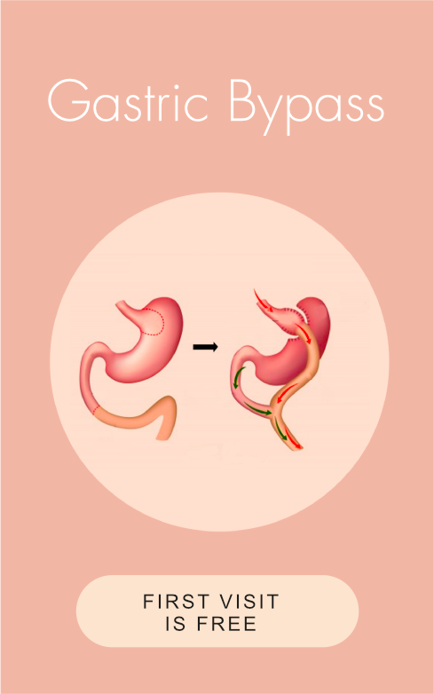 Obesidad - ByPass Gástrico