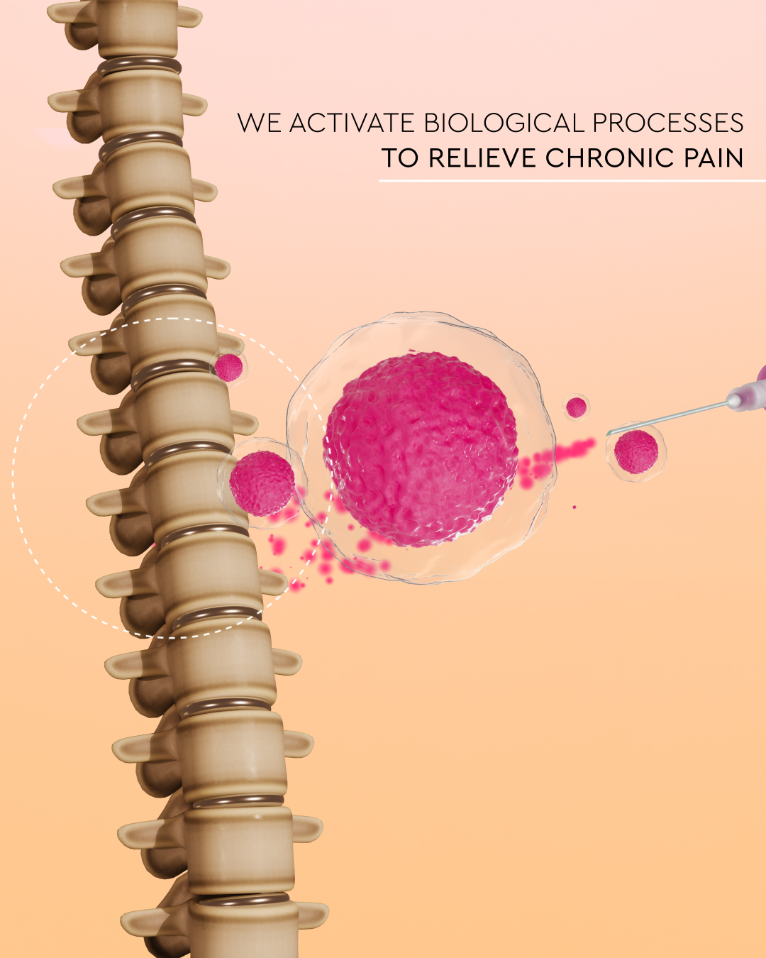 Tratamiento para el dolor lumbar