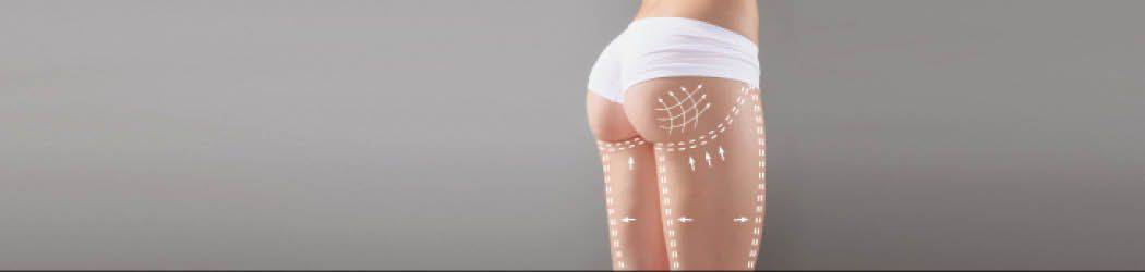 Body laxity. Thermage