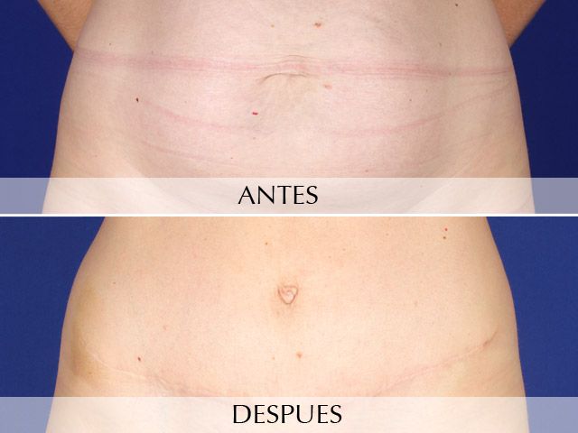 Cirugía del Abdomen | Abdominoplastia | Clínica Planas Barcelona Madrid
