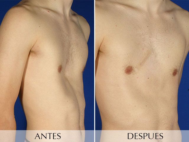 Antes y Después Pectus Excavatum