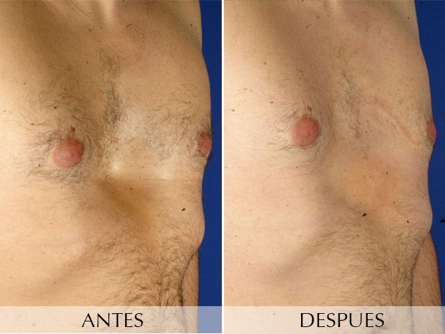 Antes y Después Pectus Excavatum