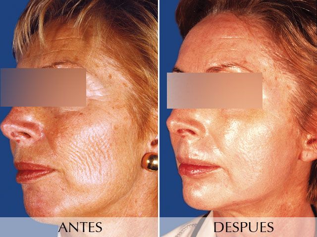 Antes y Después Rejoveniment facial - Láser