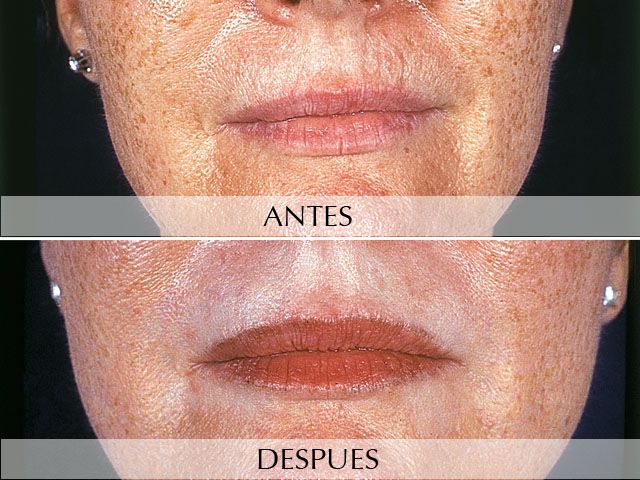 Antes y Después Laser: Facial Rejuvenation