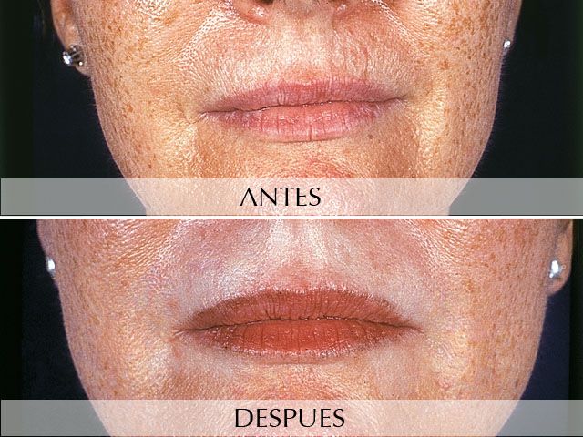 Antes y Después Rejuvenecimiento facial. Láser