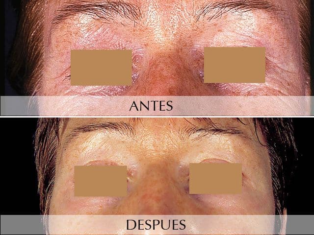 Antes y Después Rejuvenecimiento facial. Láser