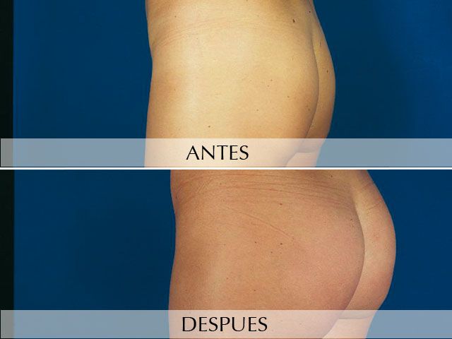 Antes y Después Augment de glutis