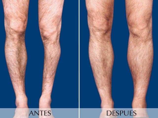 Antes y Después Calf Augmentation