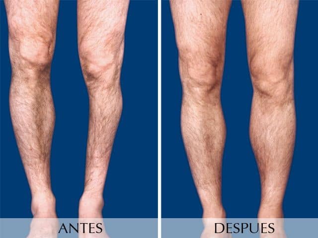 Antes y Después Calf Augmentation