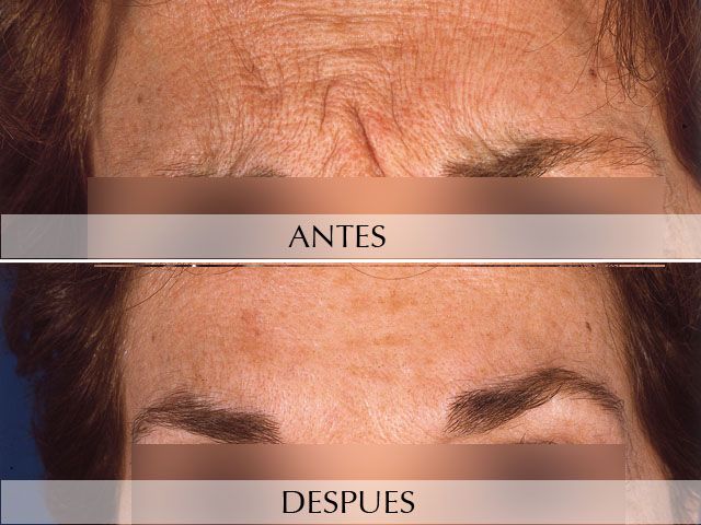 Antes y Después Expression Wrinkles