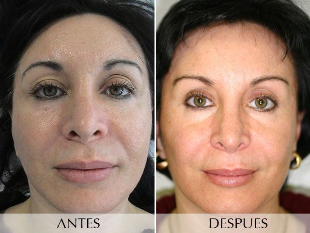 Antes y Después Expression Wrinkles
