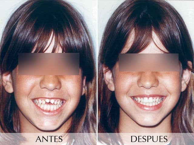 Antes y Después Porcelain Veneers