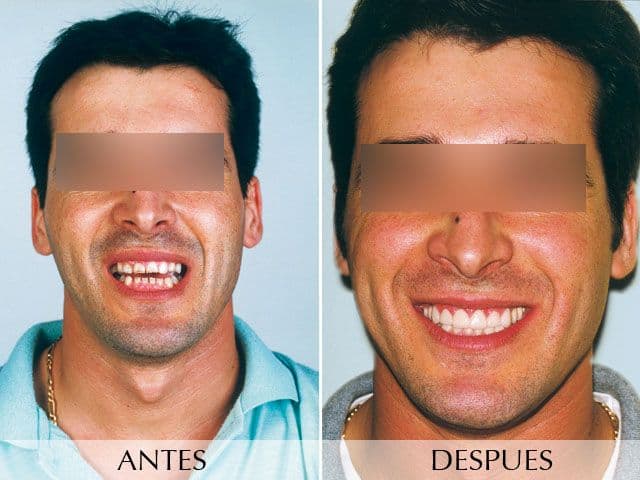 Antes y Después Facetes dentals de porcellana