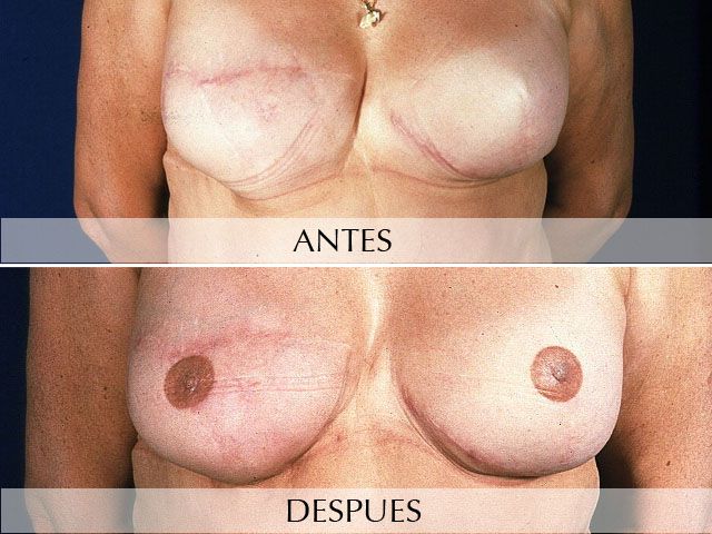 Antes y Después Micropigmentación Oncológica