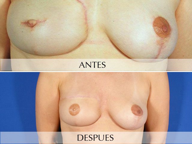 Antes y Después Micropigmentación Oncológica