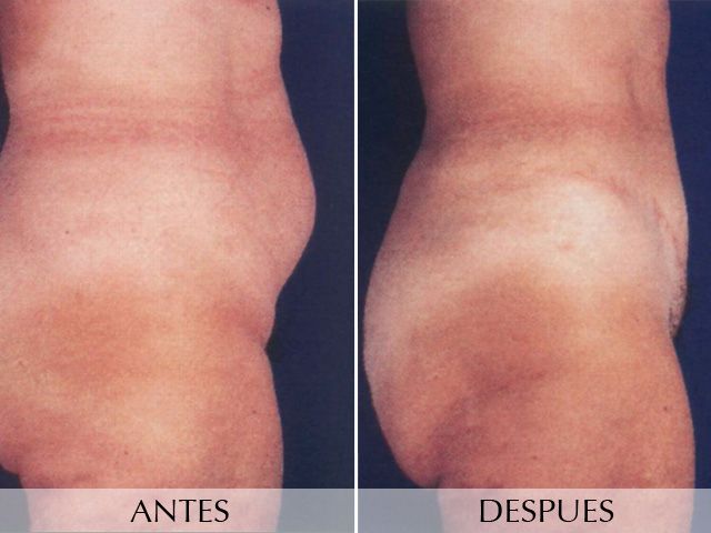 Antes y Después Abdominal Surgery