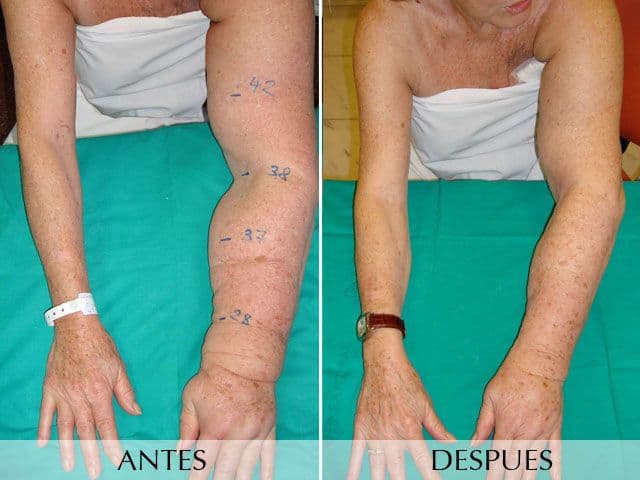 Antes y Después Operación de Linfedema