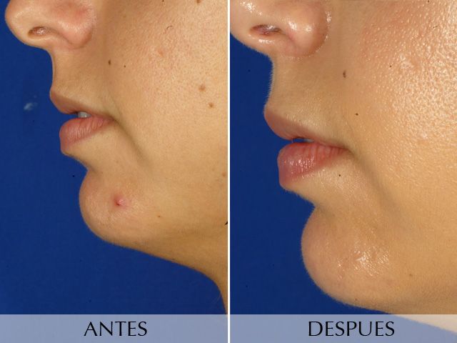 Antes y Después Cirurgia de Mentó