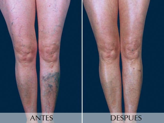 Antes y Después Operación de Varices