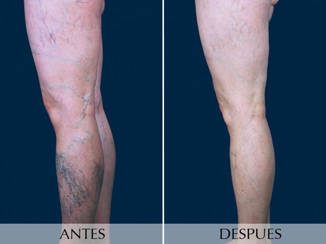 Antes y Después Varicose Vein Surgery