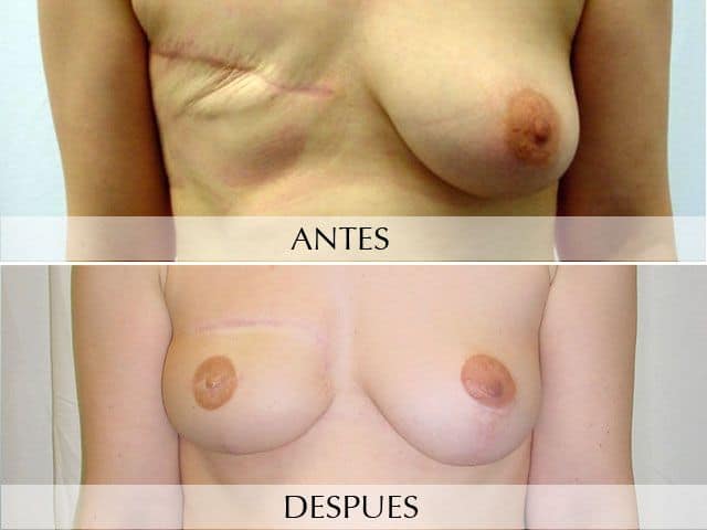 Antes y Después DIEP