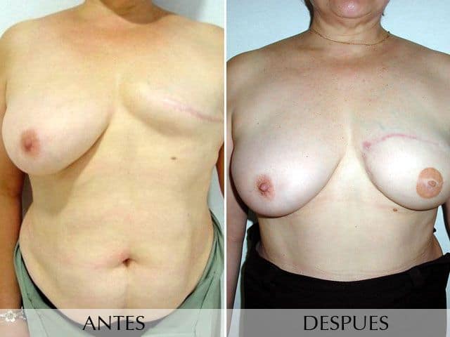 Antes y Después DIEP