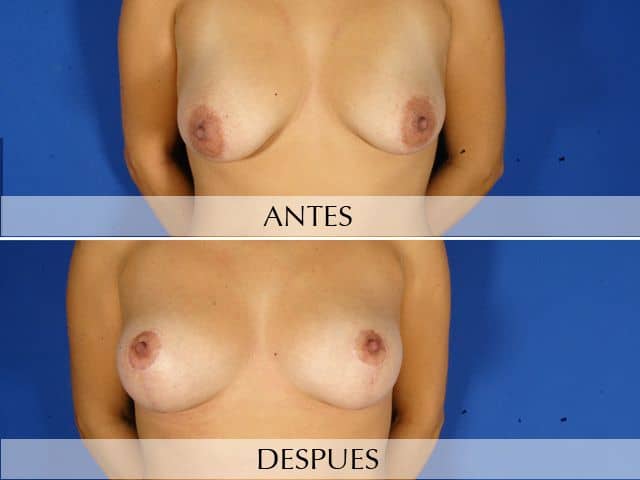 Antes y Después Breast Uplift