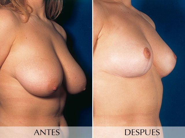 Antes y Después Breast Uplift