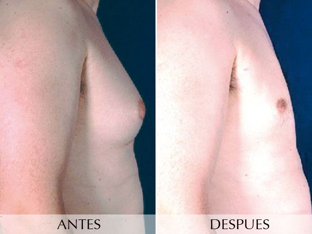 Antes y Después Gynecomastia