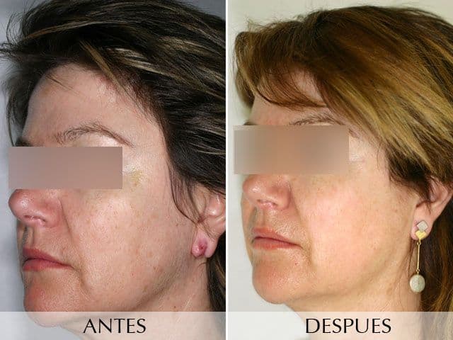 Antes y Después Unifying the Skin with IPL