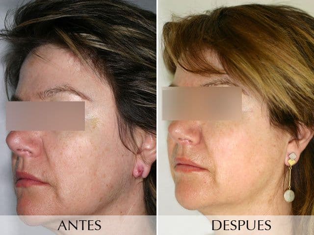 IPL: tratamiento para unificar el tono de la piel - Antes y Después - 1