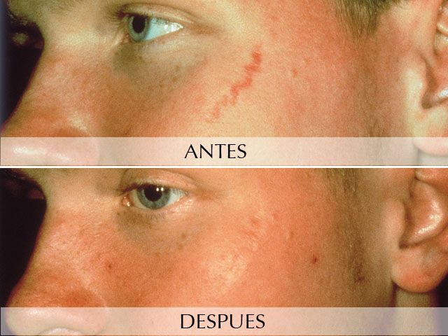 Antes y Después Arañas Vasculares