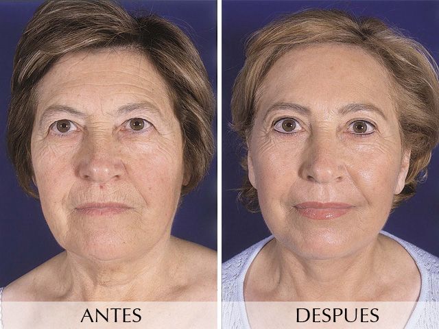 Antes y Después Face lifting