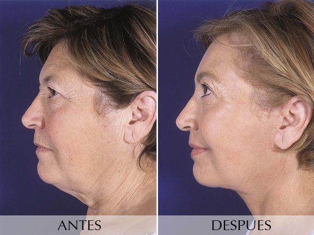 Antes y Después Face lifting