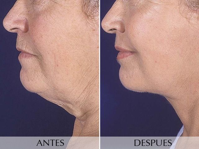 Antes y Después Lifting Facial