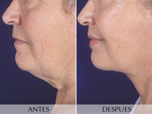 Antes y Después Face lifting