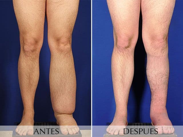 Antes y Después Cirurgia del Limfedema i Lipedema