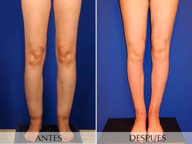 Antes y Después Cirurgia del Limfedema i Lipedema