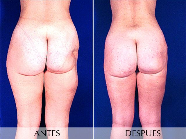 Antes y Después Body Lipostructure