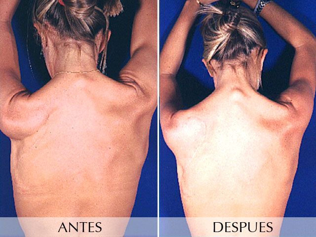 Antes y Después Lipoestructura corporal