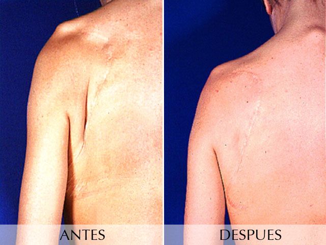 Antes y Después Lipoestructura – Coleman