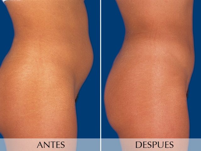 Antes y Después Liposuction