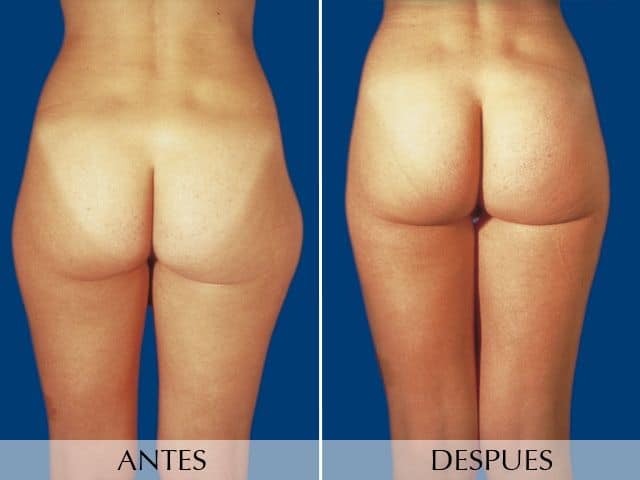 Antes y Después Liposuction