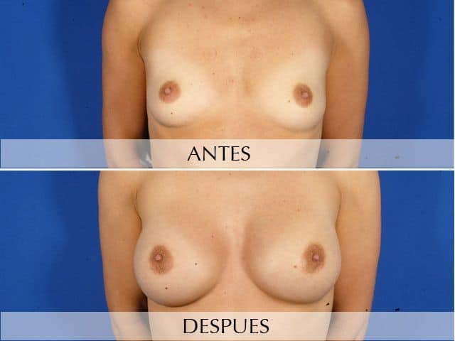 Antes y Después Augment de mames amb pròtesi