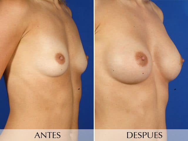 Antes y Después Augment de mames amb pròtesi