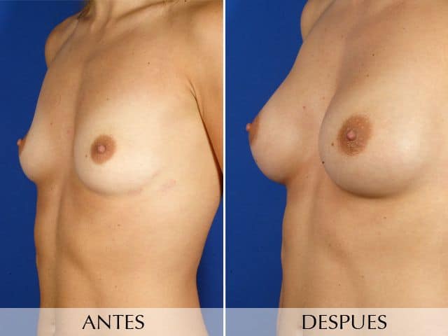 Antes y Después Augment de mames amb pròtesi