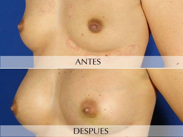 Antes y Después Breast augmentation with own fat