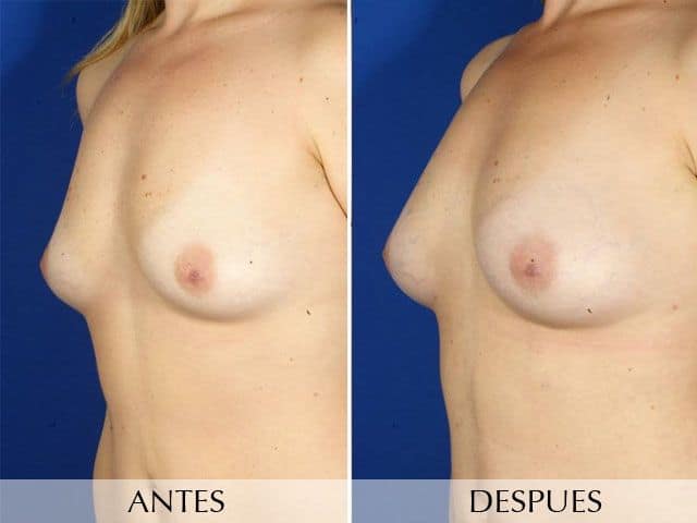 Antes y Después Breast augmentation with own fat