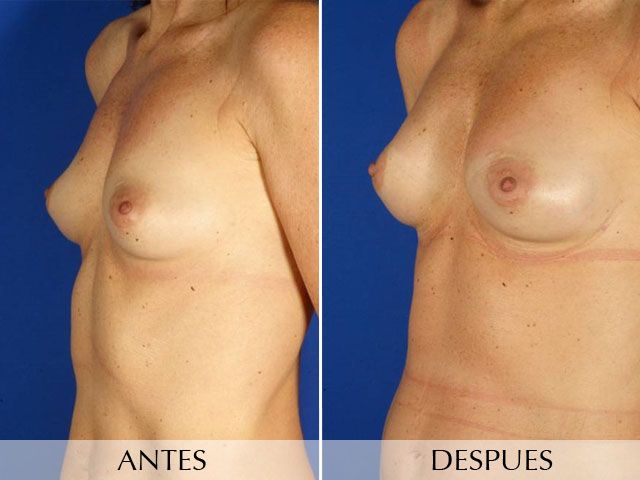 Antes y Después Breast augmentation with own fat