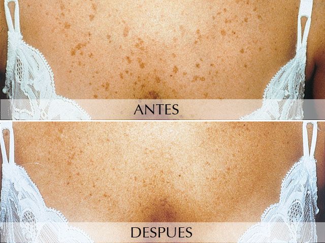 Antes y Después Manchas en la piel - Láser